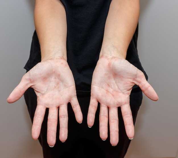 Способы лечения белого налета на коже рук